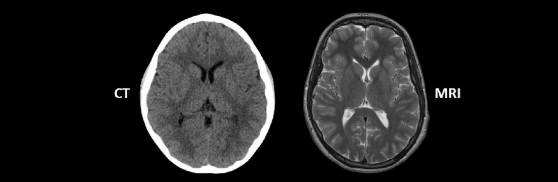 CT Brain Vs MRI Brain